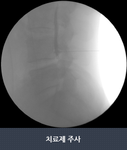 치료제 주사1