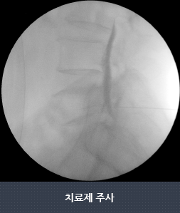 치료제 주사2