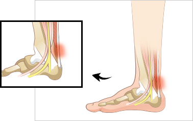 아킬레스건염 이미지