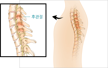 흉추 후관절 증후군 이미지