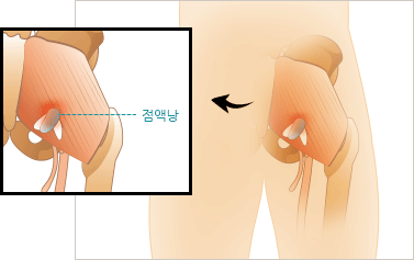 좌골 점액낭염 이미지