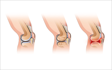 무릎 인대 손상 이미지