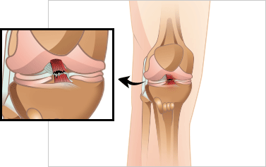 무릎 퇴행성 관절염 이미지