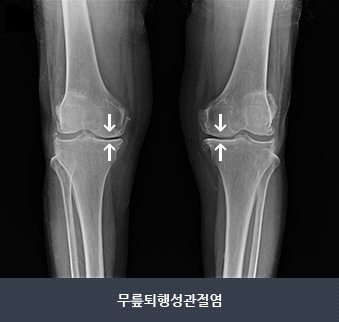 무릎 퇴행성 관절염