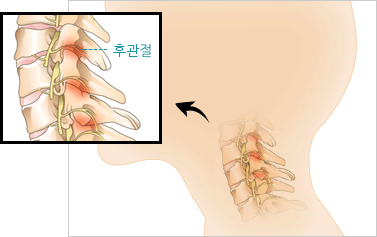 경추 후관절 증후군 이미지