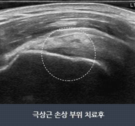 극상근 손상 부위 치료후