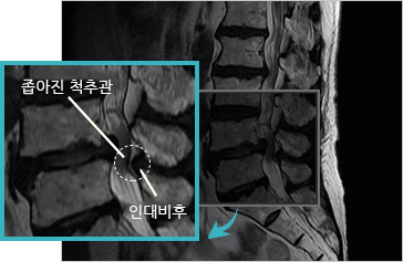 척추관협착증 이미지