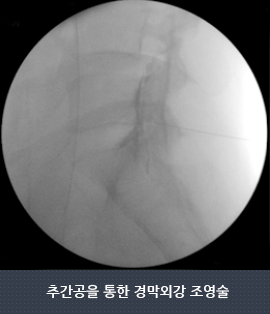 추간공을 통한 경막외강 조영술